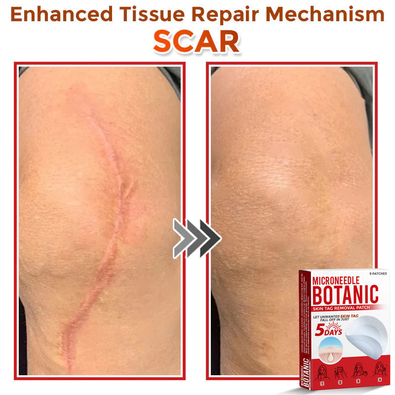 Microneedle Botanical Skin Tag Removal Patch 🇺🇸Made in the USA (FDA Certified)