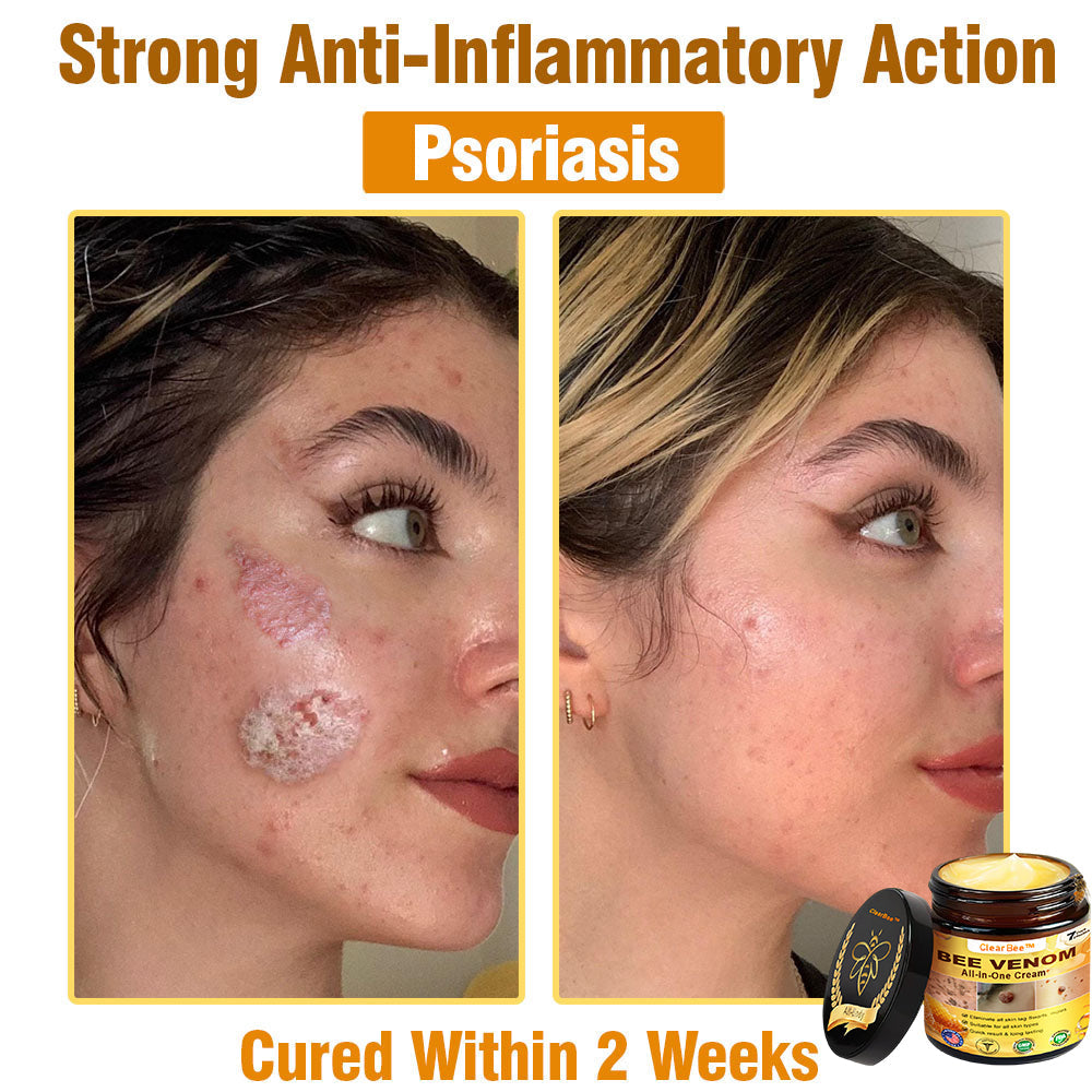 ClearBee™ Bee Venom All-in-One Cream US Dermatologist Approved🍃