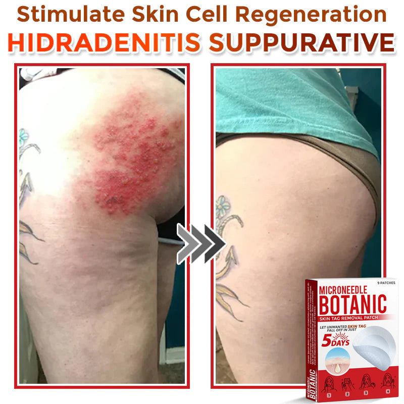 Microneedle Botanical Skin Tag Removal Patch 🇺🇸Made in the USA (FDA Certified)