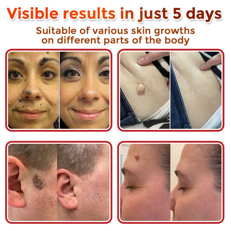 Microneedle Botanical Skin Tag Removal Patch 🇺🇸Made in the USA (FDA Certified)