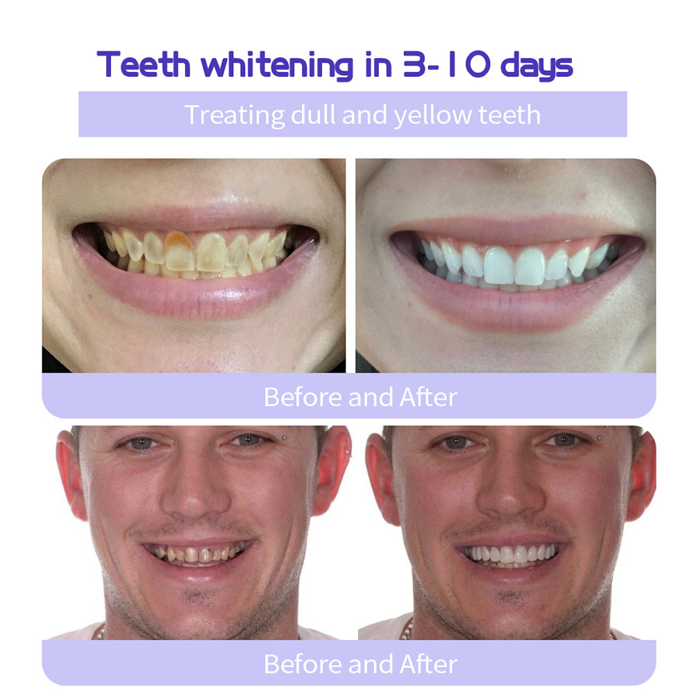 🎁Flash Sale - Don’t Miss Out - BBOJI™ TeethRestoration Mineral Powder🦷(TGA recommended)👩‍⚕️(Treats periodontitis and mouth ulcers, prevents tooth loss, and repairs gum recession)