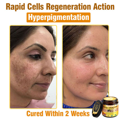 ClearBee™ Bee Venom All-in-One Cream US Dermatologist Approved🍃