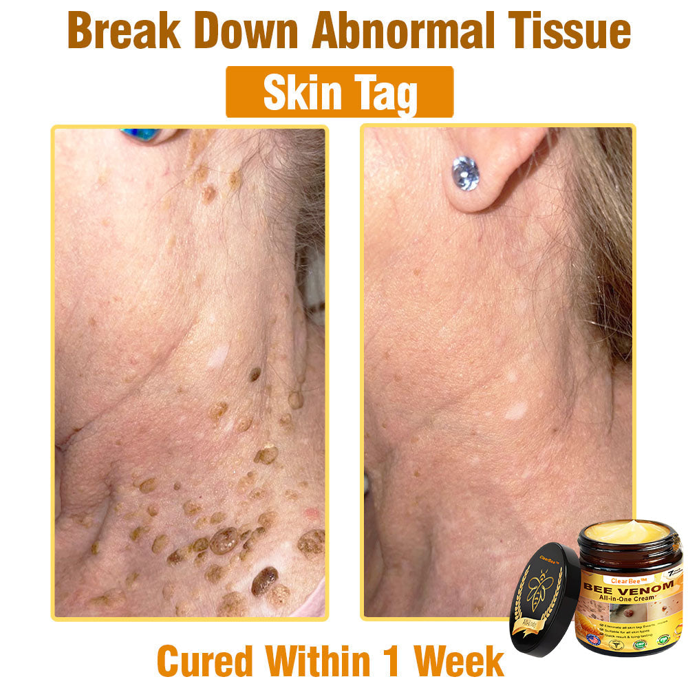 ClearBee™ Bee Venom All-in-One Cream US Dermatologist Approved🍃